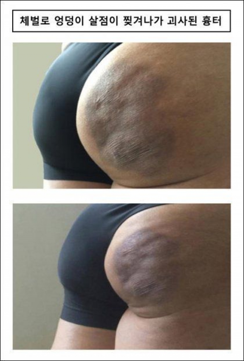 20년전 고딩때 비행청소년이었습니다. 당시 선생님 체벌로 엉덩이가 괴사한 뒤에야 정신차렸습니다.-m
